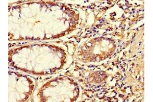 Immunohistochemistry of paraffin-embedded human colon cancer using ABIN7144761 at dilution of 1:100 (Asporin antibody  (AA 33-380))