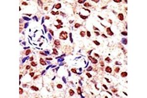 IHC analysis of FFPE human breast carcinoma tissue stained with the PRMT2 antibody