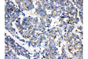 Anti- mtTFA Picoband antibody,IHC(P) IHC(P): Human Lung Cancer Tissue (TFAM antibody  (N-Term))