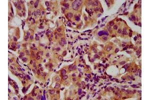 IHC image of ABIN7161101 diluted at 1:600 and staining in paraffin-embedded human lung cancer performed on a Leica BondTM system.