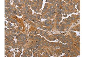 The image on the left is immunohistochemistry of paraffin-embedded Human ovarian cancer tissue using ABIN7191664(NMT1 Antibody) at dilution 1/45, on the right is treated with synthetic peptide. (NMT1 antibody)
