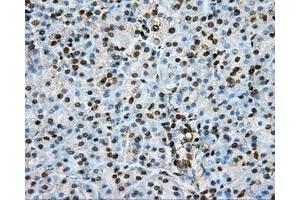 Immunohistochemical staining of paraffin-embedded Adenocarcinoma of colon tissue using anti-PTPRE mouse monoclonal antibody.
