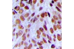 Immunohistochemical analysis of CBP80 staining in human breast cancer formalin fixed paraffin embedded tissue section. (NCBP1 antibody  (N-Term))