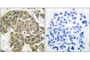 Immunohistochemistry analysis of paraffin-embedded human breast carcinoma tissue, using Mammaglobin B Antibody. (SCGB2A1 antibody  (AA 10-59))