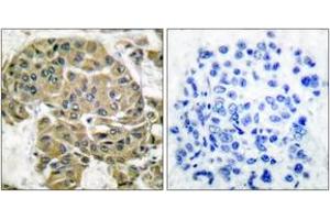 Immunohistochemistry analysis of paraffin-embedded human breast carcinoma tissue, using Mammaglobin B Antibody.
