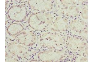 Immunohistochemistry of paraffin-embedded human gastric cancer using ABIN7161726 at dilution of 1:100 (NLE1 antibody  (AA 206-485))