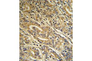 Formalin-fixed and paraffin-embedded human Prostate carcinoma reacted with ACOT8 Antibody (C-term), which was peroxidase-conjugated to the secondary antibody, followed by DAB staining. (ACOT8 antibody  (C-Term))