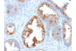 Formalin-fixed, paraffin-embedded human Prostate Carcinoma stained with AMACR / p504S Mouse Monoclonal Antibody (AMACR/1864). (AMACR antibody  (AA 297-394))