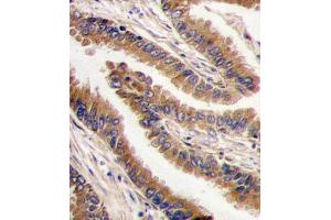 Formalin-fixed and paraffin-embedded human lung carcinoma tissue reacted with PRKX antibody , which was peroxidase-conjugated to the secondary antibody, followed by DAB staining. (PRKX antibody  (C-Term))