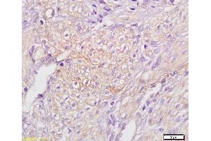 Formalin-fixed and paraffin embedded human endometrial carcinoma labeled with Anti TAP2/ABCB3 Polyclonal Antibody,Unconjugated (ABIN680123) at 1:200 followed by conjugation to the secondary antibody and DAB staining. (TAP2 antibody  (AA 451-550))