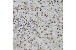 Immunohistochemistry of paraffin-embedded human liver cancer using INTS6 Antibody (ABIN2563455) at dilution of 1:100 (40x lens). (INTS6 antibody)