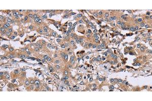 Immunohistochemistry of paraffin-embedded Human liver cancer using MAGEA3 Polyclonal Antibody at dilution of 1:50 (MAGEA3 antibody)
