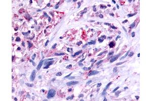 Anti-GPR45 antibody IHC of human Brain, Glioblastoma. (GPR45 antibody  (C-Term))