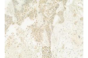 ABIN6264927 and ABIN6278743 at 1/100 staining human breast carcinoma by IHC-P.