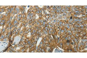 Immunohistochemistry of paraffin-embedded Human ovarian cancer tissue using SLC16A1 Polyclonal Antibody at dilution 1:50 (SLC16A1 antibody)