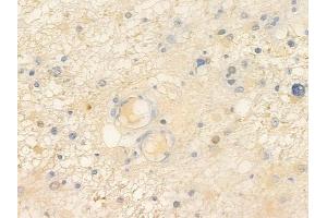 ABIN7096866 and ABIN7100932 at 1/100 staining human astrocytoma by IHC-P.