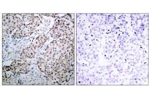 Immunohistochemical analysis of paraffin-embedded human breast carcinoma tissue using p53 (phospho- Ser315) antibody (E011100). (p53 antibody  (pSer315))
