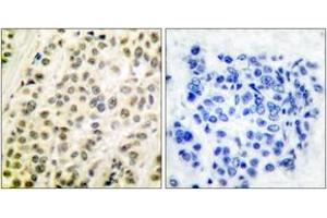 Immunohistochemistry analysis of paraffin-embedded human breast carcinoma tissue, using DP-1 Antibody.