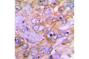 Immunohistochemical analysis of Caspase 3 staining in human lung cancer formalin fixed paraffin embedded tissue section. (Caspase 3 antibody  (Center))