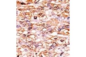 Formalin-fixed and paraffin-embedded human cancer tissue reacted with the primary antibody, which was peroxidase-conjugated to the secondary antibody, followed by AEC staining. (CDKN1B antibody  (pSer178))