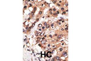 Formalin-fixed and paraffin-embedded human hepatocellular carcinoma tissue reacted with MLLT3 polyclonal antibody  , which was peroxidase-conjugated to the secondary antibody, followed by AEC staining. (AF9 antibody  (C-Term))