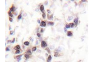 Immunohistochemistry analyzes of hnRNP C1/2 antibody in paraffin-embedded human breast carcinoma tissue. (HNRNPC antibody)