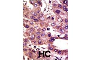 Formalin-fixed and paraffin-embedded human cancer tissue reacted with the primary antibody, which was peroxidase-conjugated to the secondary antibody, followed by DAB staining. (AMFR antibody  (AA 571-601))