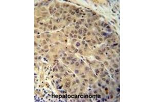 BUD13 antibody (C-term) immunohistochemistry analysis in formalin fixed and paraffin embedded human hepatocarcinoma followed by peroxidase conjugation of the secondary antibody and DAB staining. (BUD13 antibody  (C-Term))