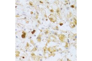 Immunohistochemistry of paraffin-embedded human brain astrocytoma using FCN1 Antibody. (FCN1 antibody  (AA 30-326))