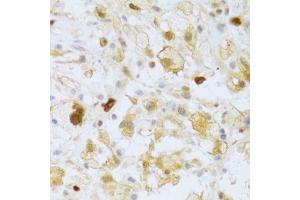 Immunohistochemistry of paraffin-embedded human brain astrocytoma using FCN1 Antibody. (FCN1 antibody  (AA 30-326))