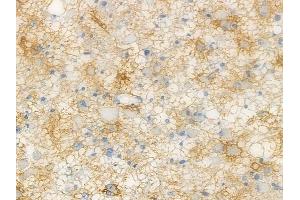 ABIN6264730 and ABIN6272560 at 1/100 staining human astrocytoma by IHC-P.