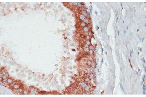 Immunohistochemistry of paraffin-embedded Human mammary cancer using PGK2 Polyclonal Antibody at dilution of 1:100 (40x lens). (PGK2 antibody)