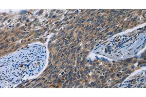 Immunohistochemistry of paraffin-embedded Human cervical cancer tissue using SYT3 Polyclonal Antibody at dilution 1:40 (Synaptotagmin 3 antibody)