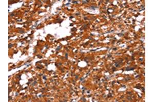 The image on the left is immunohistochemistry of paraffin-embedded Human thyroid cancer tissue using ABIN7190641(FEM1A Antibody) at dilution 1/20, on the right is treated with synthetic peptide.