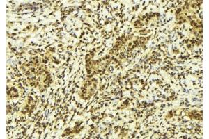 ABIN6278125 at 1/100 staining Human breast cancer tissue by IHC-P. (UNG antibody  (Internal Region))