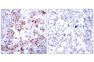 Immunohistochemical analysis of paraffin- embedded human breast carcinoma tissue using ATF-2 (Ab-69 or 51) antibody(E021030). (ATF2 antibody)