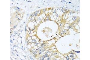 Immunohistochemistry of paraffin-embedded Human colon carcinoma using GNAI3 Polyclonal Antibody at dilution of 1:100 (40x lens). (GNAI3 antibody)