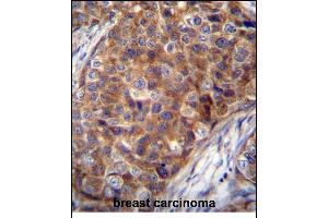 COX7A2L Antibody (Center) (ABIN656272 and ABIN2845583) immunohistochemistry analysis in formalin fixed and paraffin embedded human breast carcinoma followed by peroxidase conjugation of the secondary antibody and DAB staining. (COX7A2L antibody  (AA 37-65))