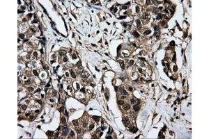 Immunohistochemical staining of paraffin-embedded liver tissue using anti-DCXRmouse monoclonal antibody. (DCXR antibody)