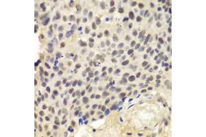 Immunohistochemistry of paraffin-embedded human lung cancer using KPNA1 antibody (ABIN5970872) at dilution of 1/100 (40x lens).
