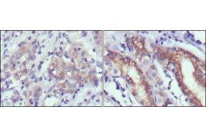 Immunohistochemical analysis of paraffin-embedded human gastric cancer (left) and normal gastric tissues (right) using CER1 antibody with DAB staining.