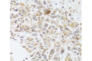 Immunohistochemistry of paraffin-embedded Human lung cancer using RNASEL Polyclonal Antibody at dilution of 1:100 (40x lens). (RNASEL antibody)