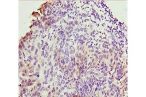 Immunohistochemistry of paraffin-embedded human bladder cancer using ABIN7173219 at dilution of 1:100 (TMEM43 antibody  (AA 80-310))