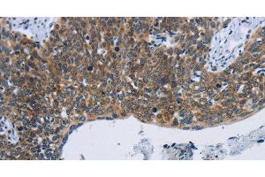 Immunohistochemistry of paraffin-embedded Human cervical cancer tissue using KPNB1 Polyclonal Antibody at dilution 1:40 (KPNB1 antibody)