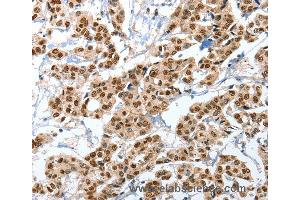 Immunohistochemistry of Human liver cancer using ANXA10 Polyclonal Antibody at dilution of 1:35 (Annexin a10 antibody)