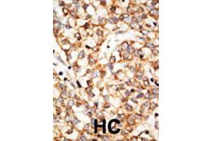 Formalin-fixed and paraffin-embedded human hepatocellular carcinoma tissue reacted with the APOBEC1 polyclonal antibody  , which was peroxidase-conjugated to the secondary antibody, followed by DAB staining. (APOBEC1 antibody  (N-Term))