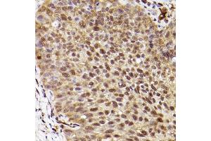 Immunohistochemistry of paraffin-embedded human lung cancer using ERK1 Rabbit mAb  at dilution of 1:100 (40x lens). (ERK1 antibody)