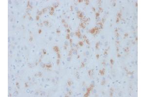 Formalin-fixed, paraffin-embedded human Hepatic Carcinoma stained with Cytochrome p450 Mouse Monoclonal Antibody (M12P4H2). (CYP2E1 antibody  (C-Term))