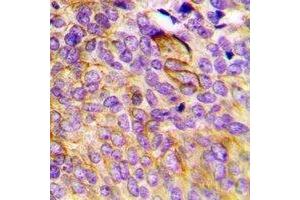 Immunohistochemical analysis of CCBL1 staining in human breast cancer formalin fixed paraffin embedded tissue section.