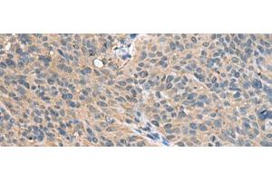 Immunohistochemistry of paraffin-embedded Human cervical cancer tissue using FAM19A4 Polyclonal Antibody at dilution of 1:55(x200) (FAM19A4 antibody)